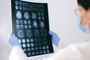 Clinician holds up brain MRI scan. Could cGMP and tau proteins help scientists find a potential Alzheimer's treatment?